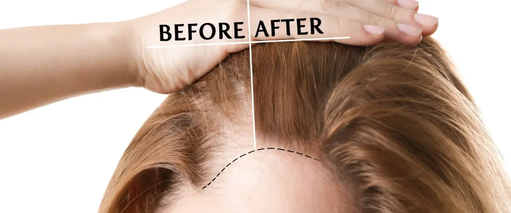 before and after of hair line showing improved hair thickness